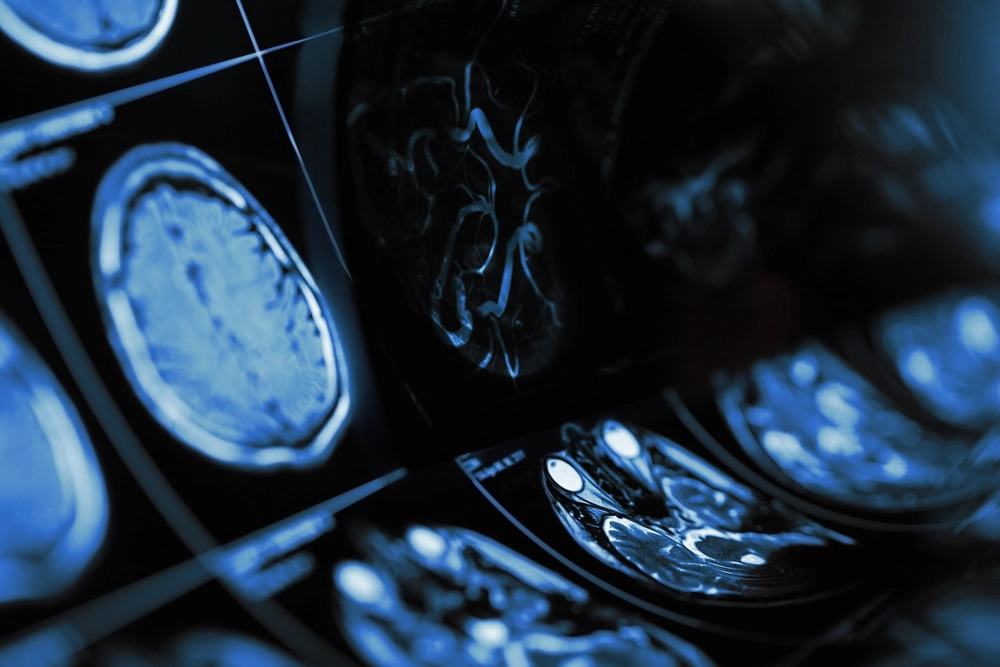 Drug-Resistant Epilepsy Prediction using Deep Learning